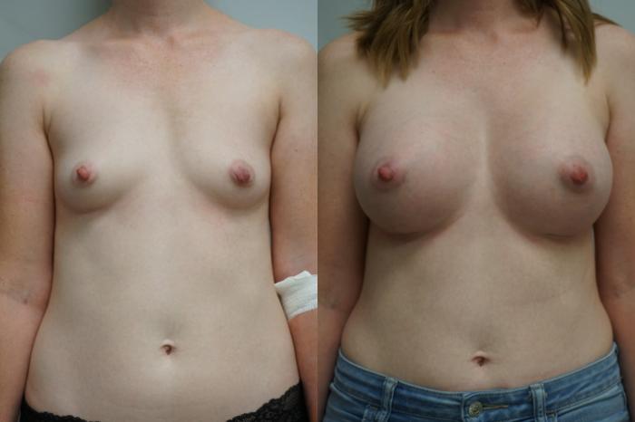 Before & After Breast Augmentation Case 298 Front View in Gilbert, AZ