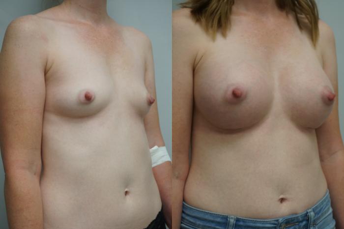 Before & After Breast Augmentation Case 298 Right Oblique View in Gilbert, AZ