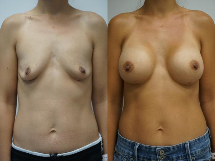Before & After Breast Augmentation Case 302 Front View in Gilbert, AZ