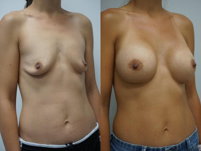 Before & After Breast Augmentation Case 302 Right Oblique View in Gilbert, AZ
