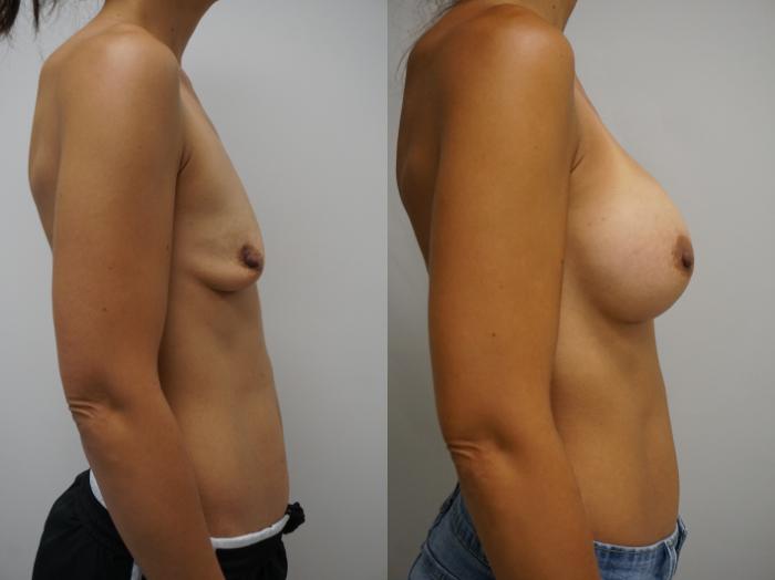 Before & After Breast Augmentation Case 302 Right Side View in Gilbert, AZ