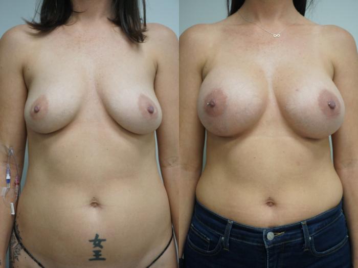 Before & After Breast Augmentation Case 307 Front View in Gilbert, AZ