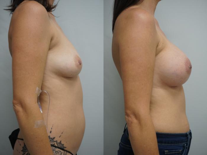 Before & After Breast Augmentation Case 307 Right Side View in Gilbert, AZ