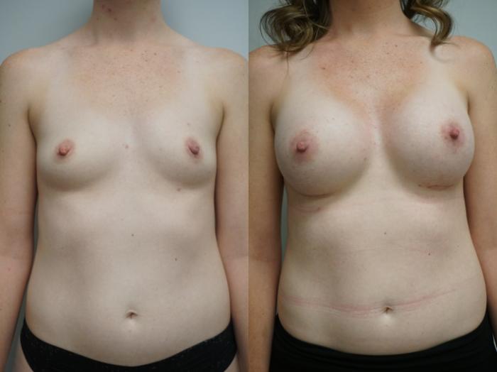 Before & After Breast Augmentation Case 311 Front View in Gilbert, AZ