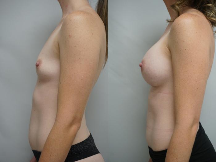 Before & After Breast Augmentation Case 311 Left Side View in Gilbert, AZ