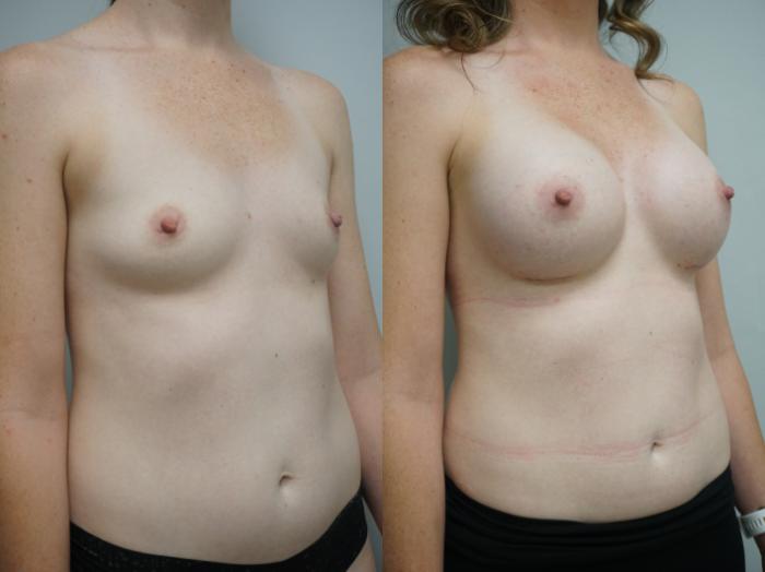 Before & After Breast Augmentation Case 311 Right Oblique View in Gilbert, AZ