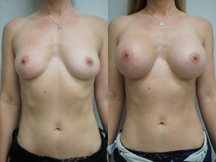 Before & After Breast Augmentation Case 312 Front View in Gilbert, AZ