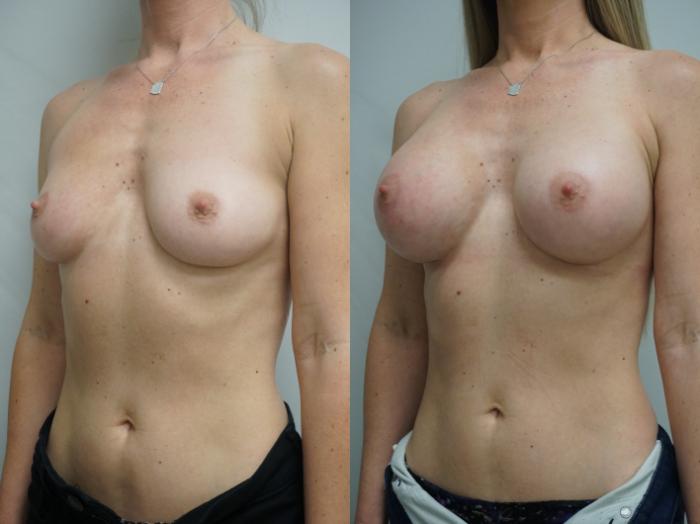 Before & After Breast Augmentation Case 312 Left Oblique View in Gilbert, AZ