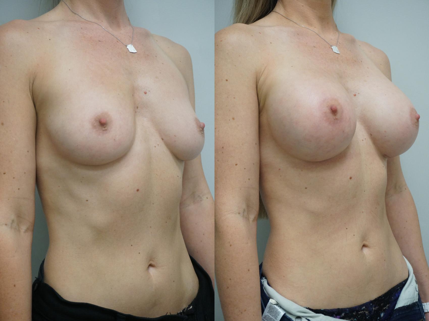Before & After Breast Augmentation Case 312 Right Oblique View in Gilbert, AZ
