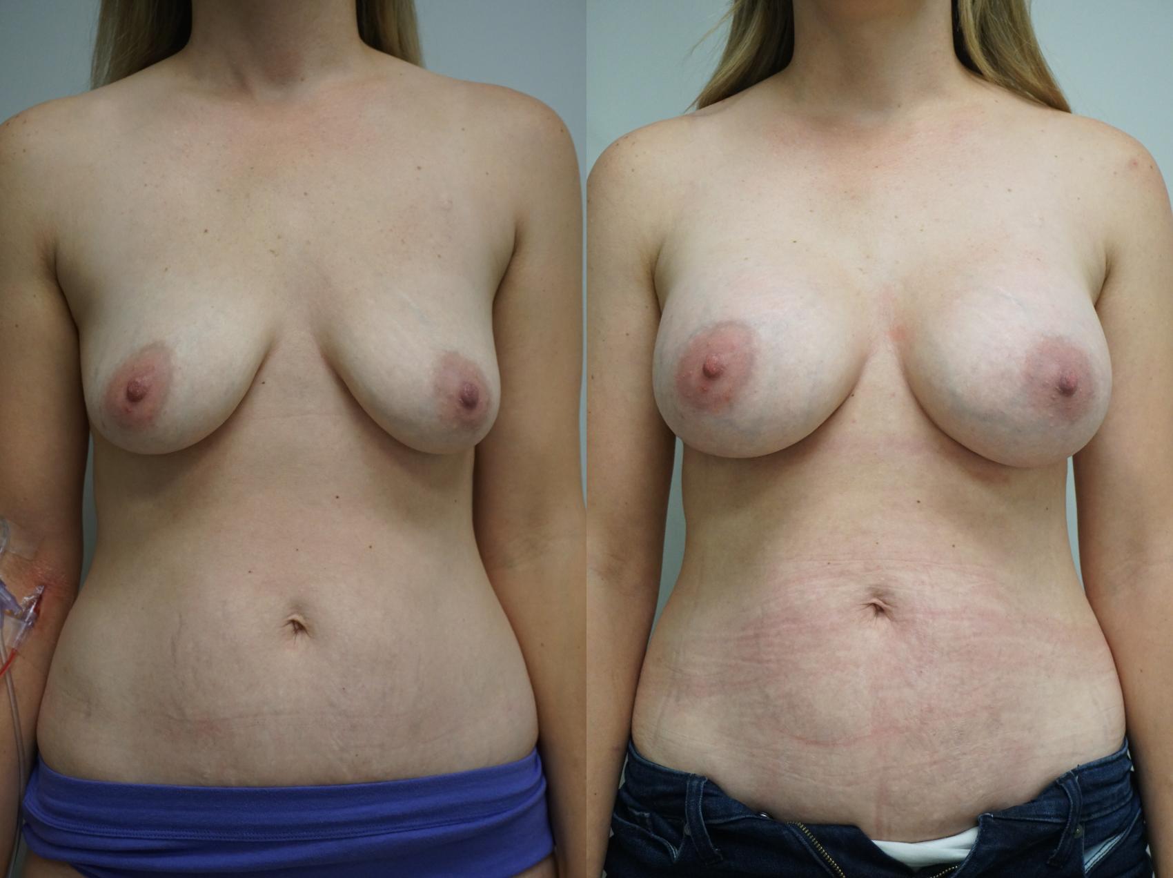 Before & After Breast Augmentation Case 313 Front View in Gilbert, AZ