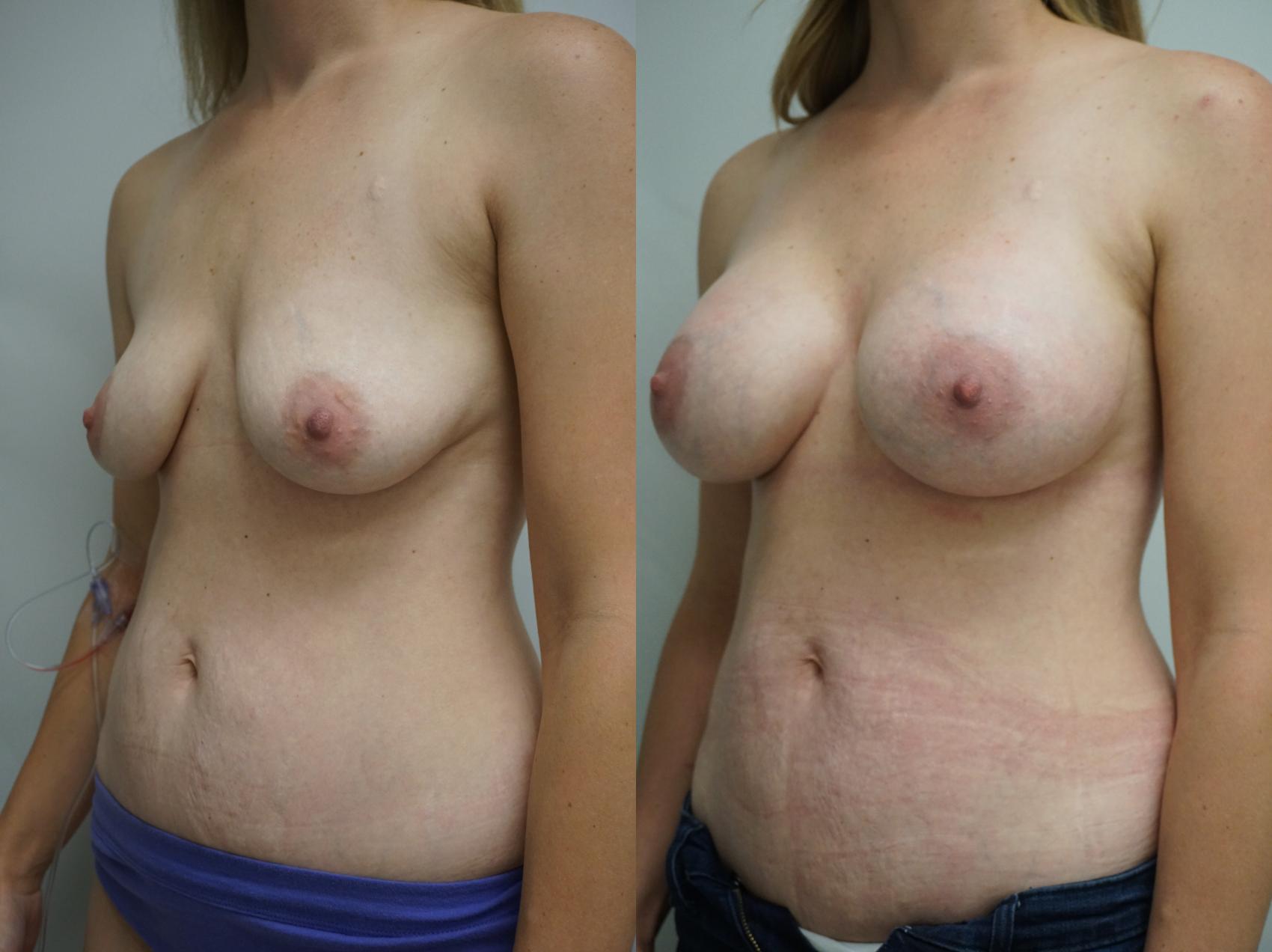 Before & After Breast Augmentation Case 313 Left Oblique View in Gilbert, AZ