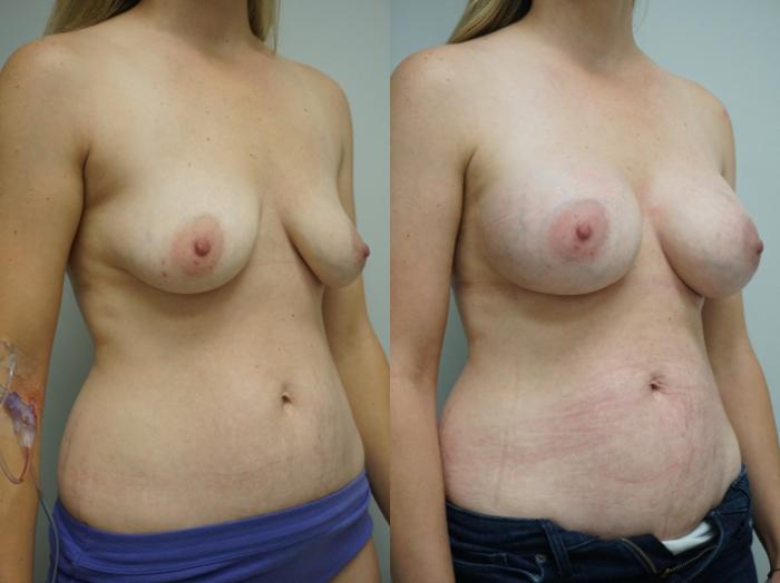 Before & After Breast Augmentation Case 313 Right Oblique View in Gilbert, AZ