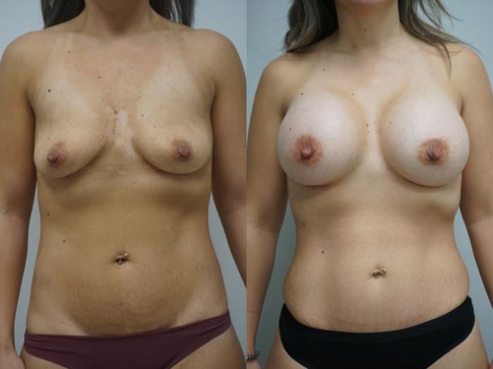 Before & After Breast Augmentation Case 315 Front View in Gilbert, AZ