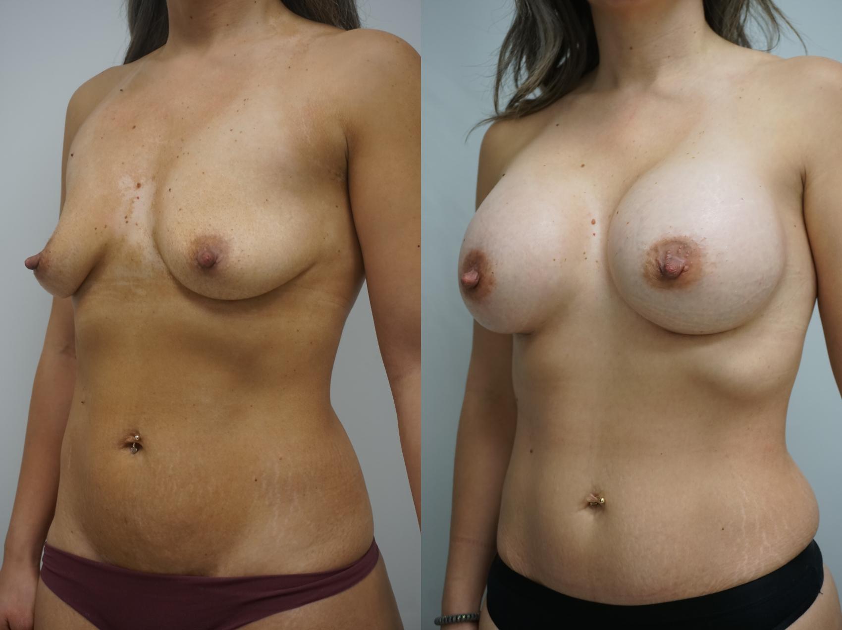 Before & After Breast Augmentation Case 315 Left Oblique View in Gilbert, AZ