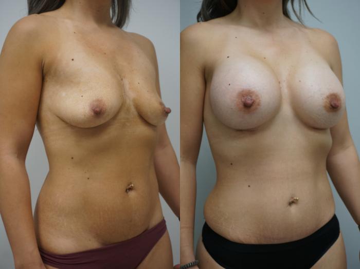 Before & After Breast Augmentation Case 315 Right Oblique View in Gilbert, AZ