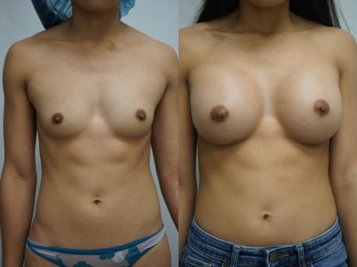 Before & After Breast Augmentation Case 316 Front View in Gilbert, AZ