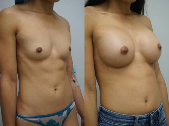 Before & After Breast Augmentation Case 316 Right Oblique View in Gilbert, AZ