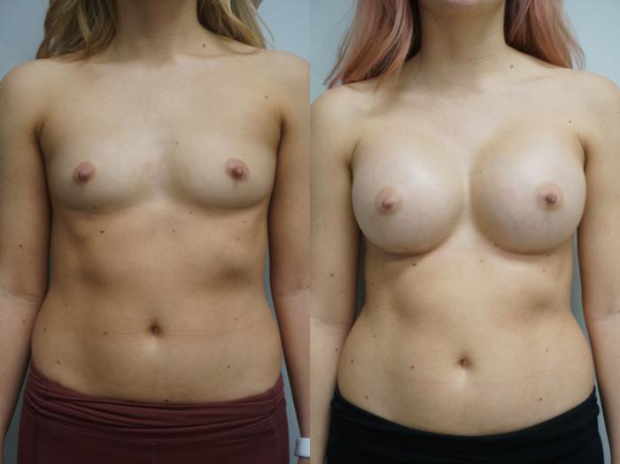 Before & After Breast Augmentation Case 318 Front View in Gilbert, AZ