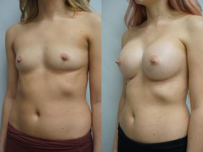 Before & After Breast Augmentation Case 318 Left Oblique View in Gilbert, AZ