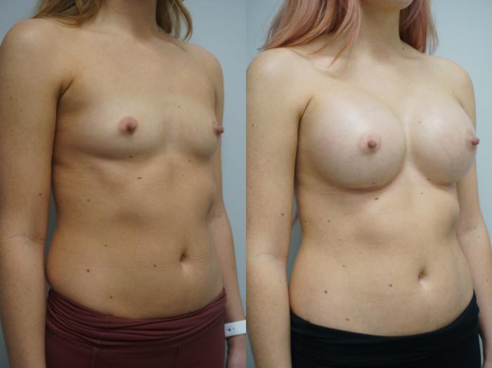 Before & After Breast Augmentation Case 318 Right Oblique View in Gilbert, AZ