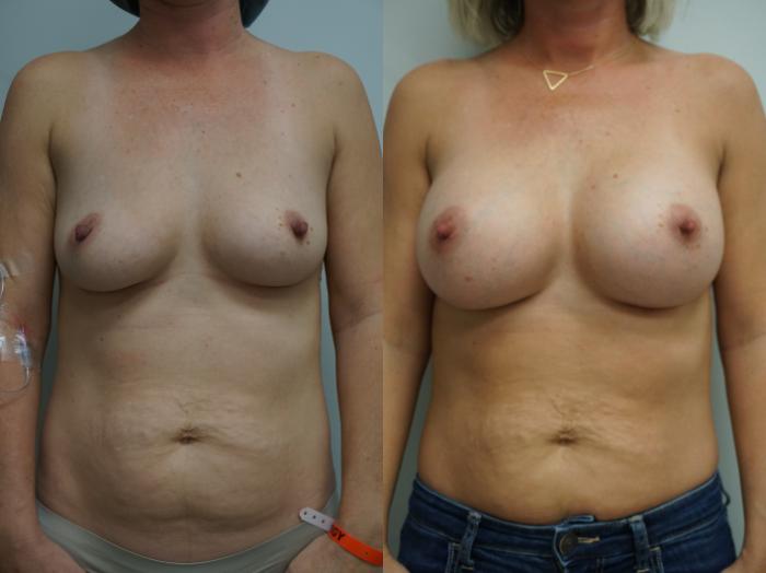 Before & After Breast Augmentation Case 319 Front View in Gilbert, AZ