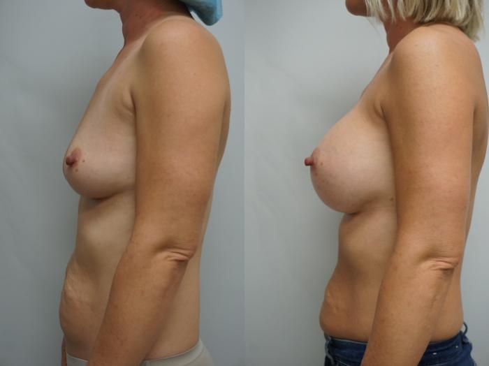 Before & After Breast Augmentation Case 319 Left Side View in Gilbert, AZ