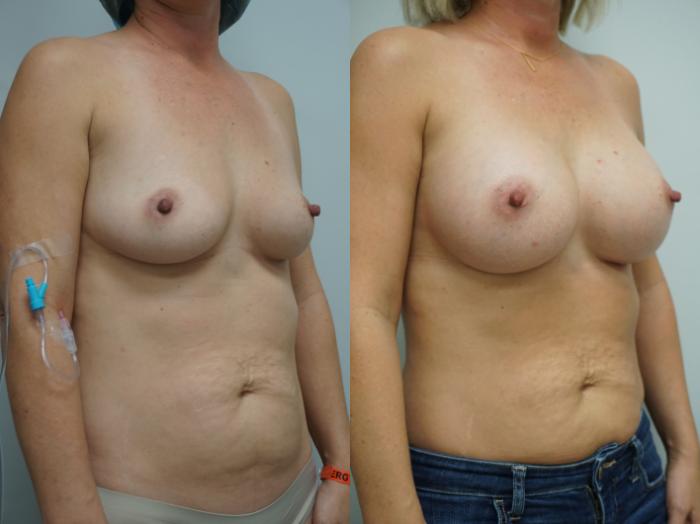 Before & After Breast Augmentation Case 319 Right Oblique View in Gilbert, AZ