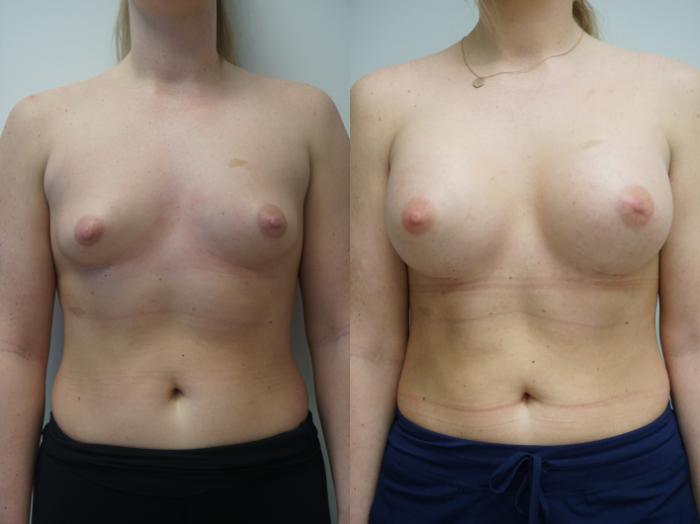 Before & After Breast Augmentation Case 320 Front View in Gilbert, AZ