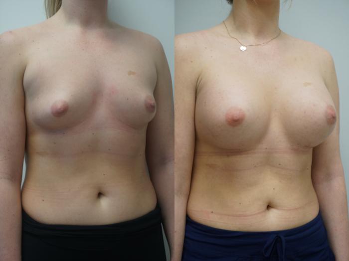 Before & After Breast Augmentation Case 320 Right Oblique View in Gilbert, AZ