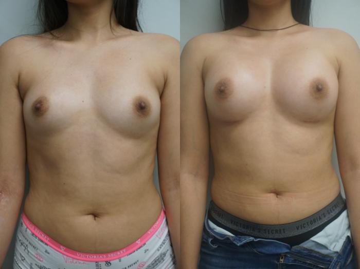 Before & After Breast Augmentation Case 322 Front View in Gilbert, AZ
