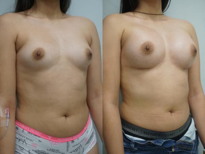 Before & After Breast Augmentation Case 322 Right Oblique View in Gilbert, AZ