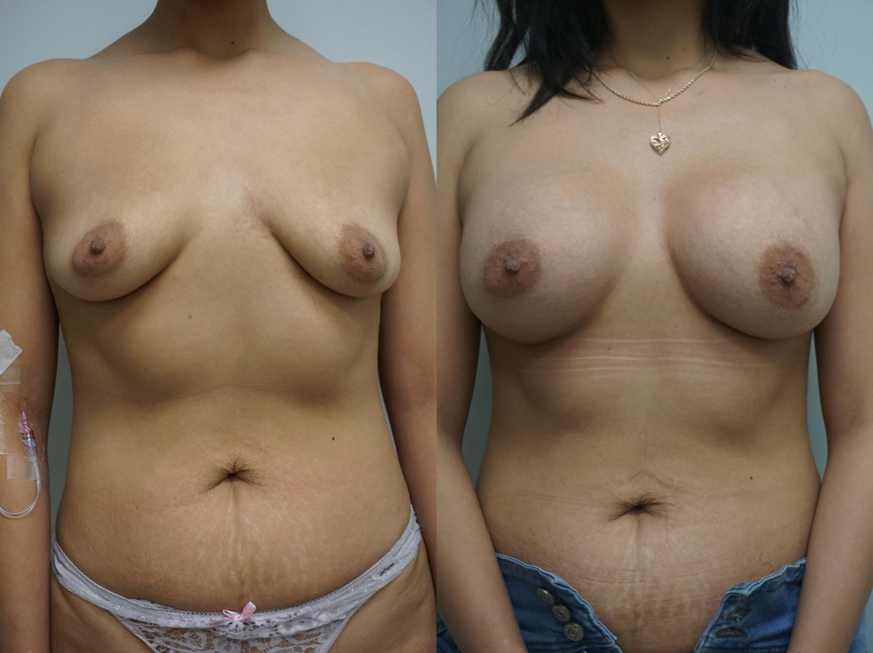 Before & After Breast Augmentation Case 332 Front View in Gilbert, AZ