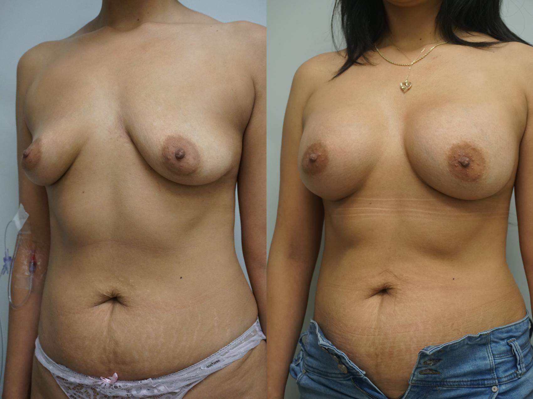 Before & After Breast Augmentation Case 332 Left Oblique View in Gilbert, AZ