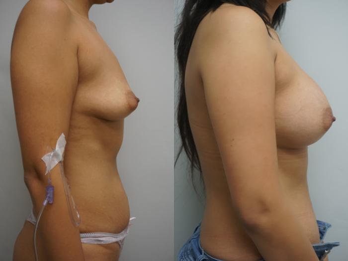 Before & After Breast Augmentation Case 332 Left Side View in Gilbert, AZ