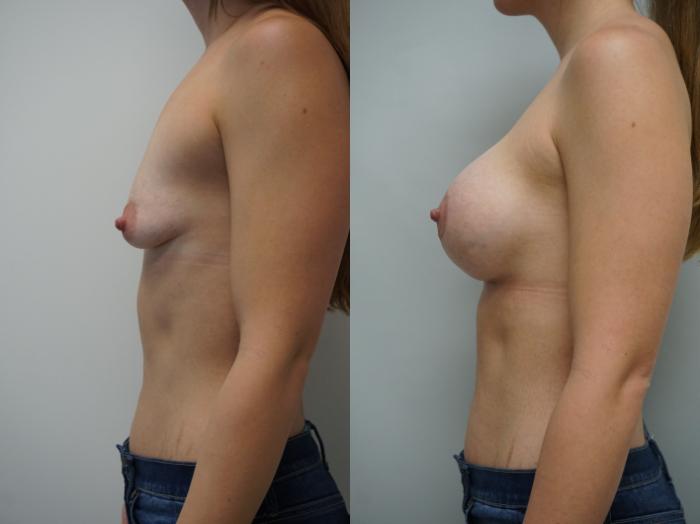 Before & After Breast Augmentation with Breast Lift  Case 338 Left Side View in Gilbert, AZ