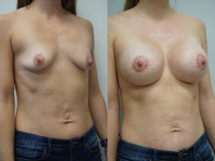 Before & After Breast Augmentation with Breast Lift  Case 338 Right Oblique View in Gilbert, AZ