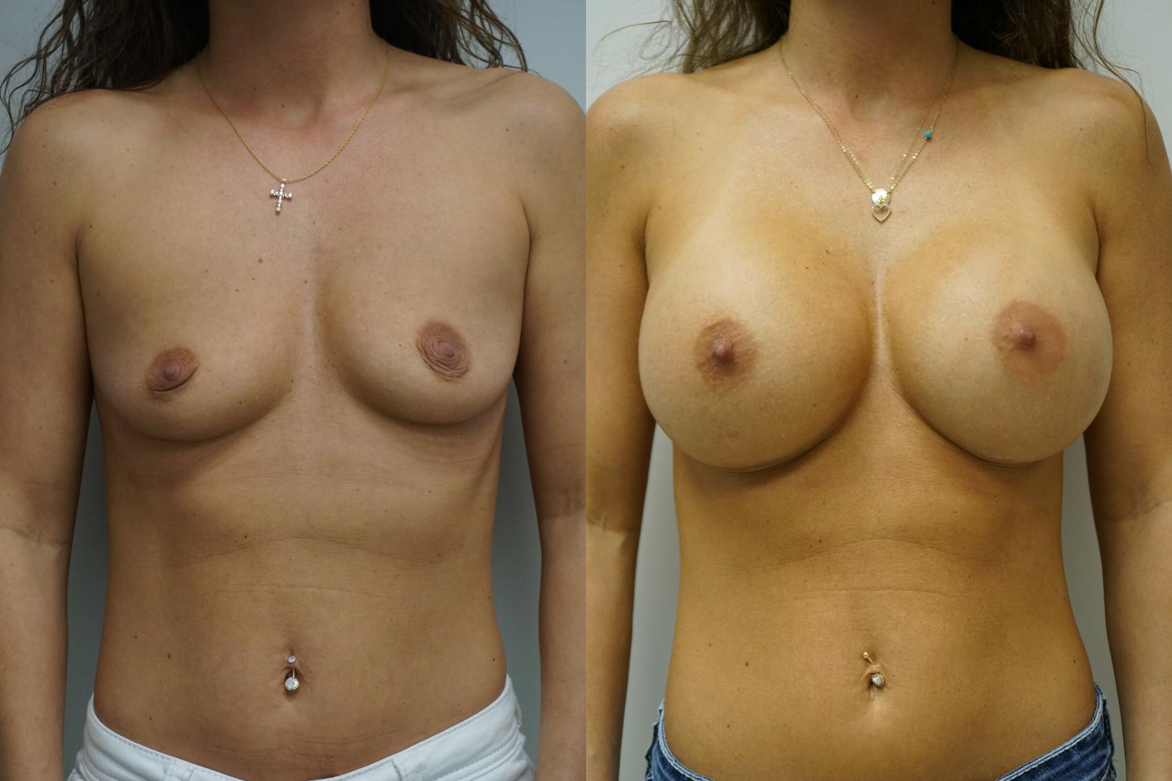 Before & After Breast Augmentation Case 342 Front View in Gilbert, AZ