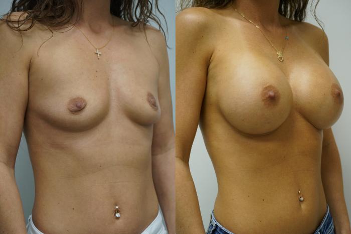 Before & After Breast Augmentation Case 342 Right Side View in Gilbert, AZ