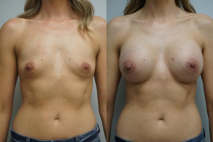 Before & After Breast Augmentation Case 344 Front View in Gilbert, AZ
