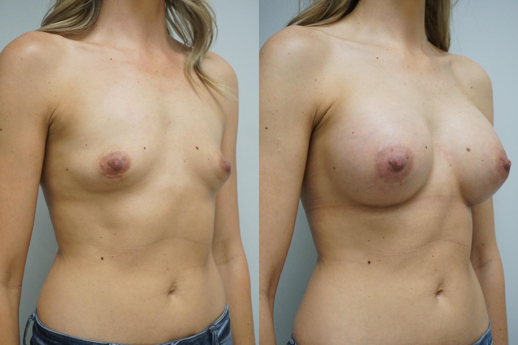 Before & After Breast Augmentation Case 344 Right Oblique View in Gilbert, AZ