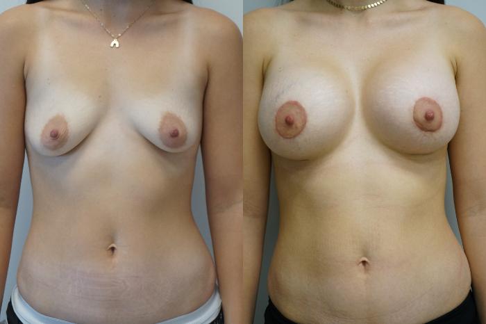 Before & After Breast Augmentation with Breast Lift  Case 346 Front View in Gilbert, AZ