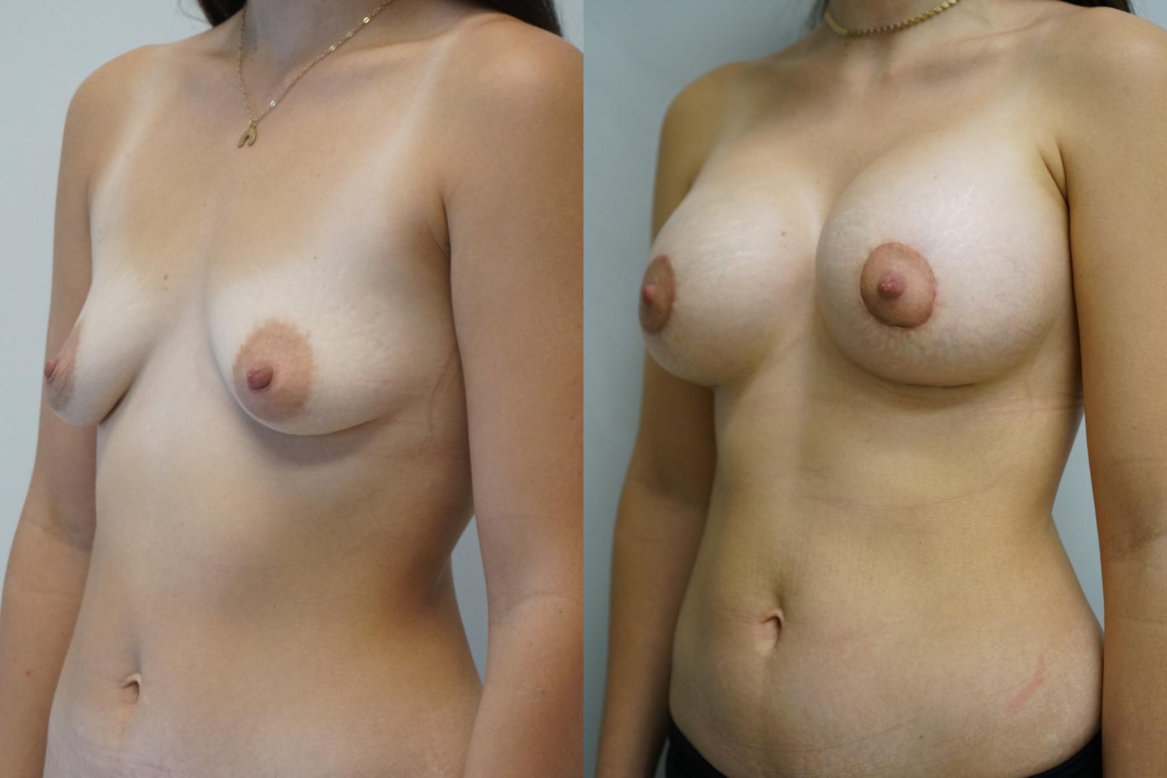 Before & After Breast Augmentation with Breast Lift  Case 346 Left Oblique View in Gilbert, AZ