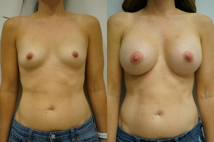 Before & After Breast Augmentation Case 352 Front View in Gilbert, AZ