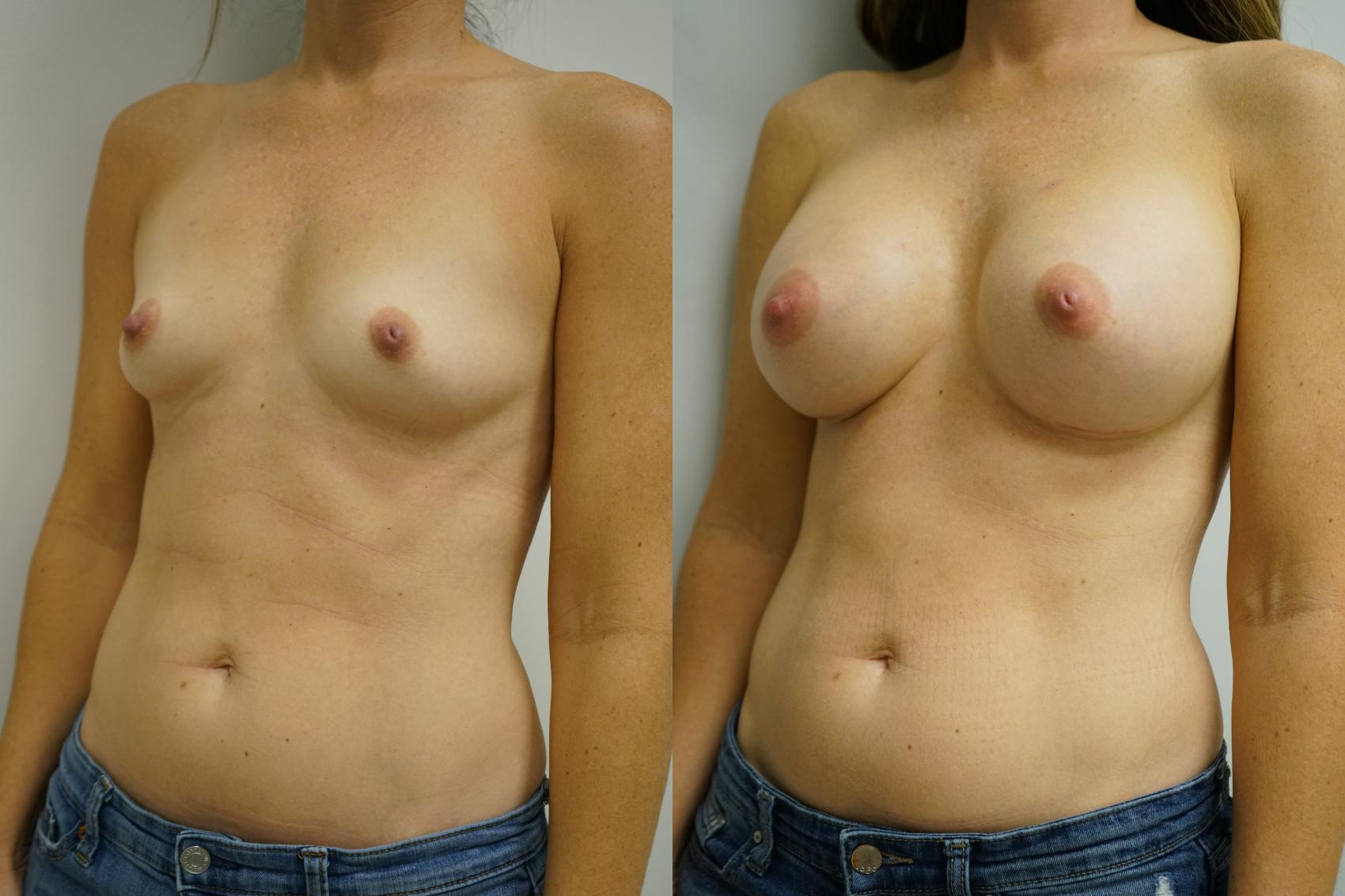 Before & After Breast Augmentation Case 352 Left Oblique View in Gilbert, AZ