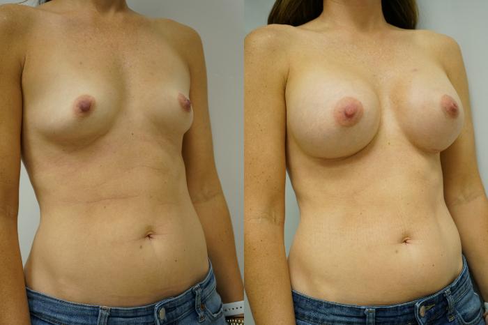 Before & After Breast Augmentation Case 352 Right Oblique View in Gilbert, AZ
