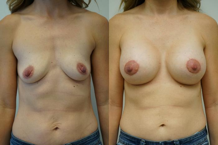Before & After Breast Augmentation Case 353 Front View in Gilbert, AZ