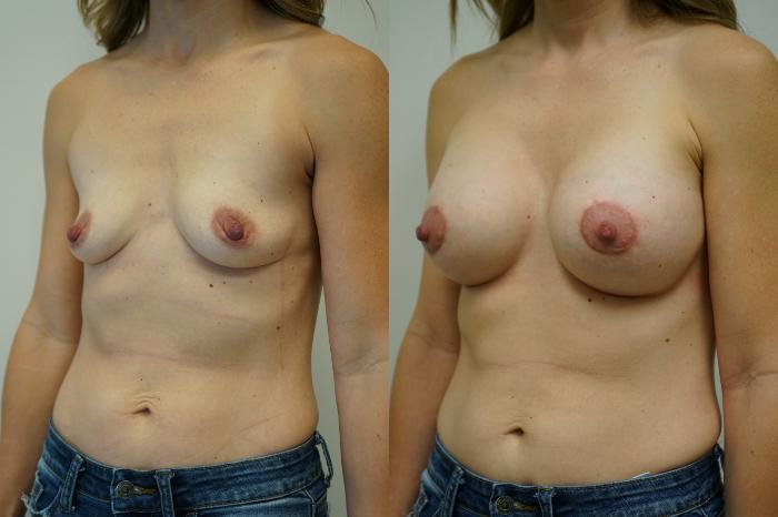 Before & After Breast Augmentation Case 353 Left Oblique View in Gilbert, AZ