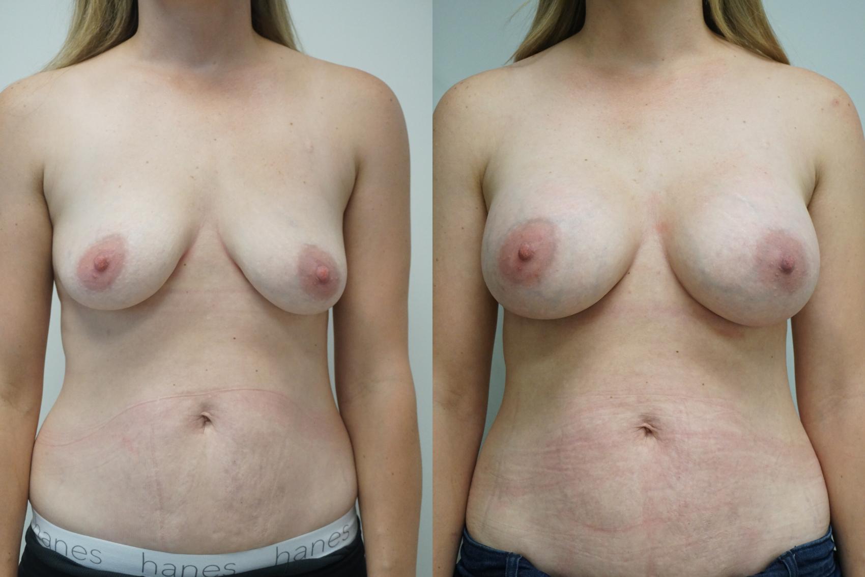 Before & After Breast Augmentation Case 355 Front View in Gilbert, AZ