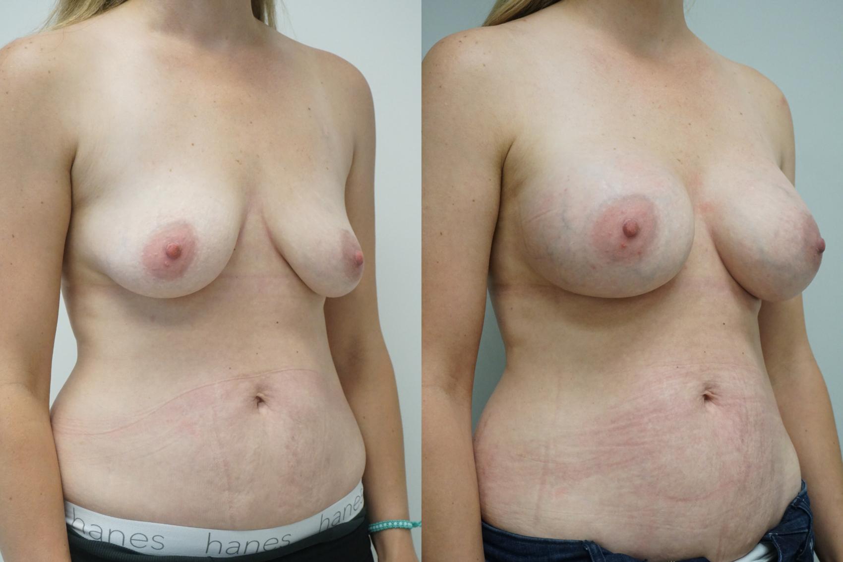 Before & After Breast Augmentation Case 355 Right Oblique View in Gilbert, AZ