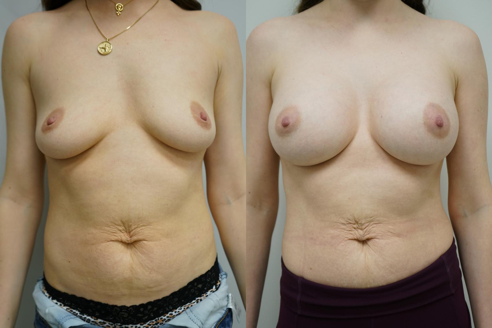 Before & After Breast Augmentation Case 357 Front View in Gilbert, AZ